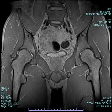 股関節MRI